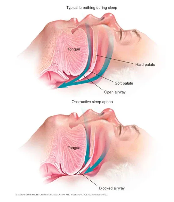 Airway Issue